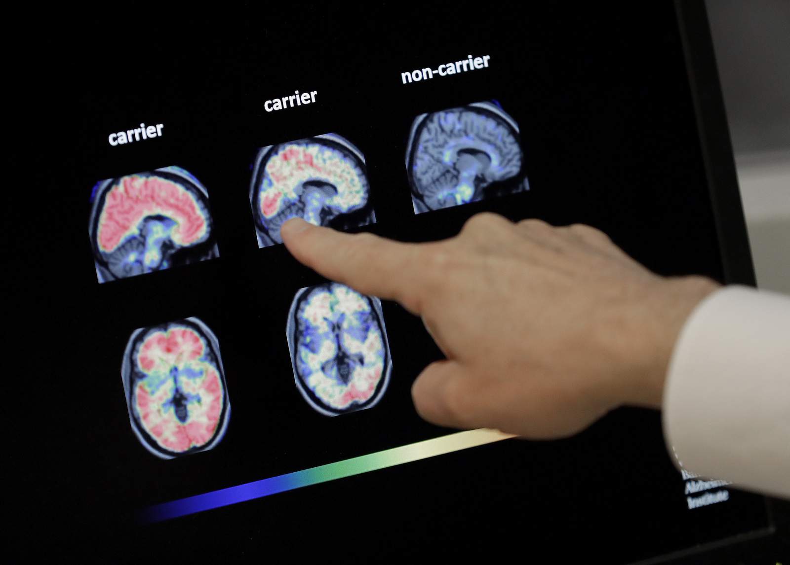 Medicare coverage for Alzheimer brain scans in question