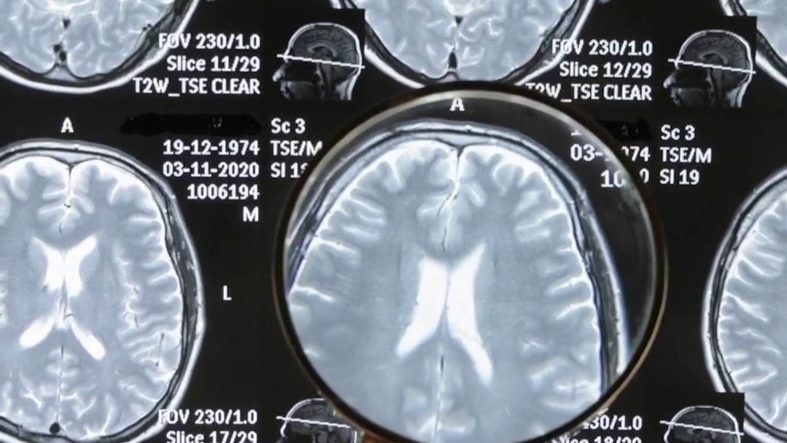 San Antonio researchers examining COVID-19’s long-term effects on the brain