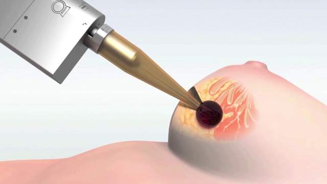 Brachytherapy: One-time treatment for early breast cancer