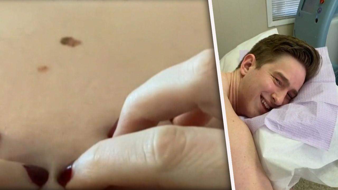 TikTok Star Alex Griswold Has Pre-Cancerous Mole Removed After Viewer Spots It in Video