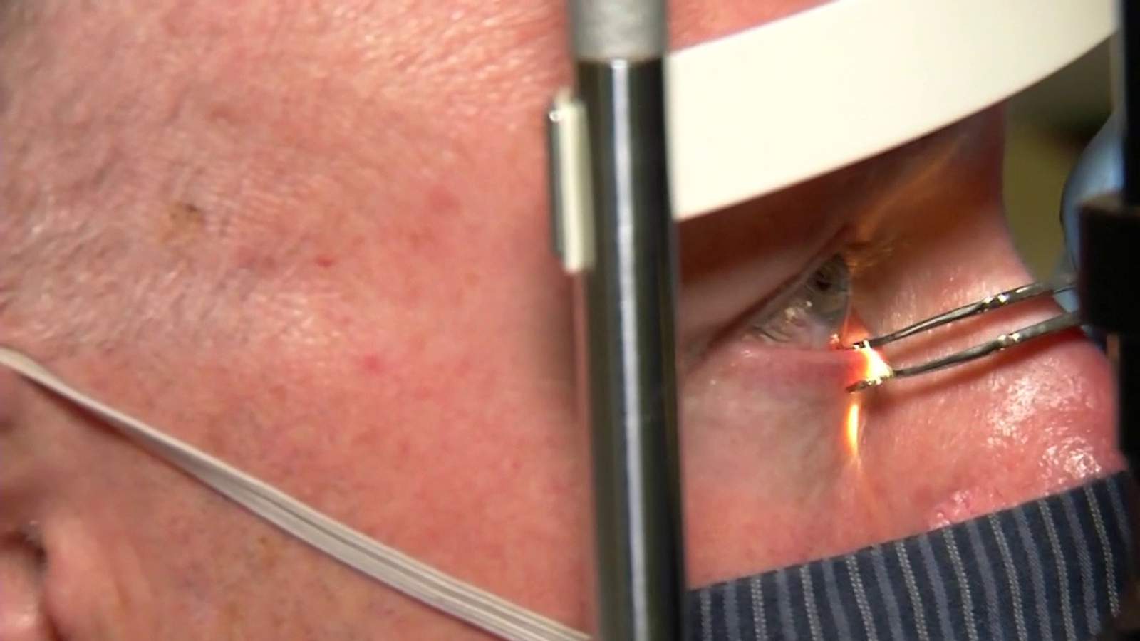 TearCare wearable device defeats dry eye