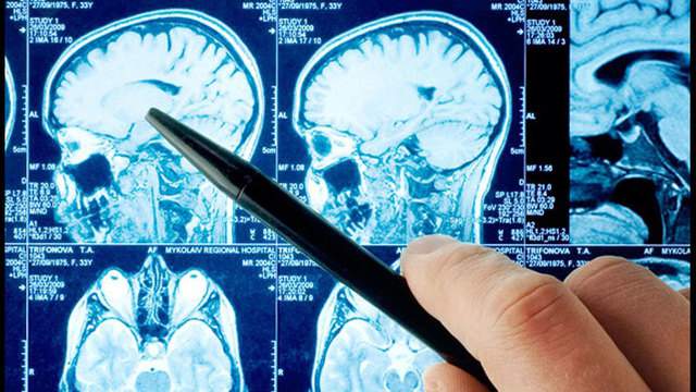 COVID-19 likely to impact the brain, San Antonio researchers find