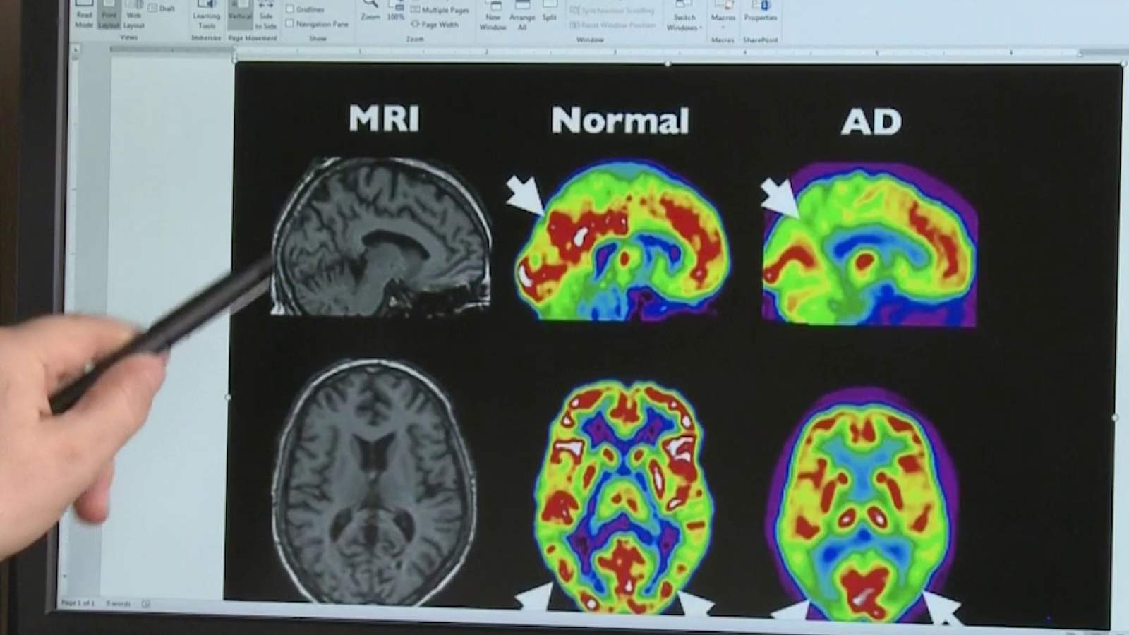 Women more likely to suffer from Alzheimer’s disease, experts say